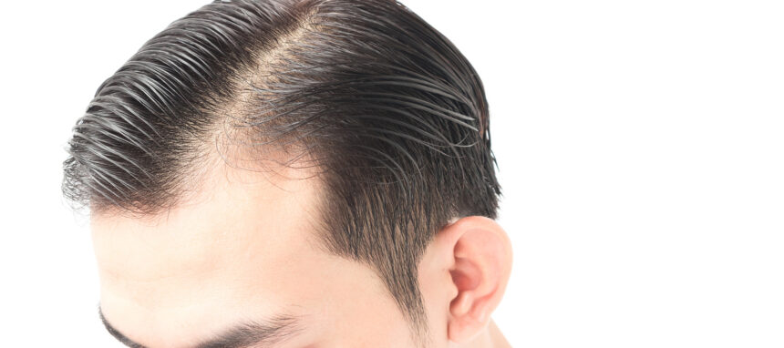 Hair Loss